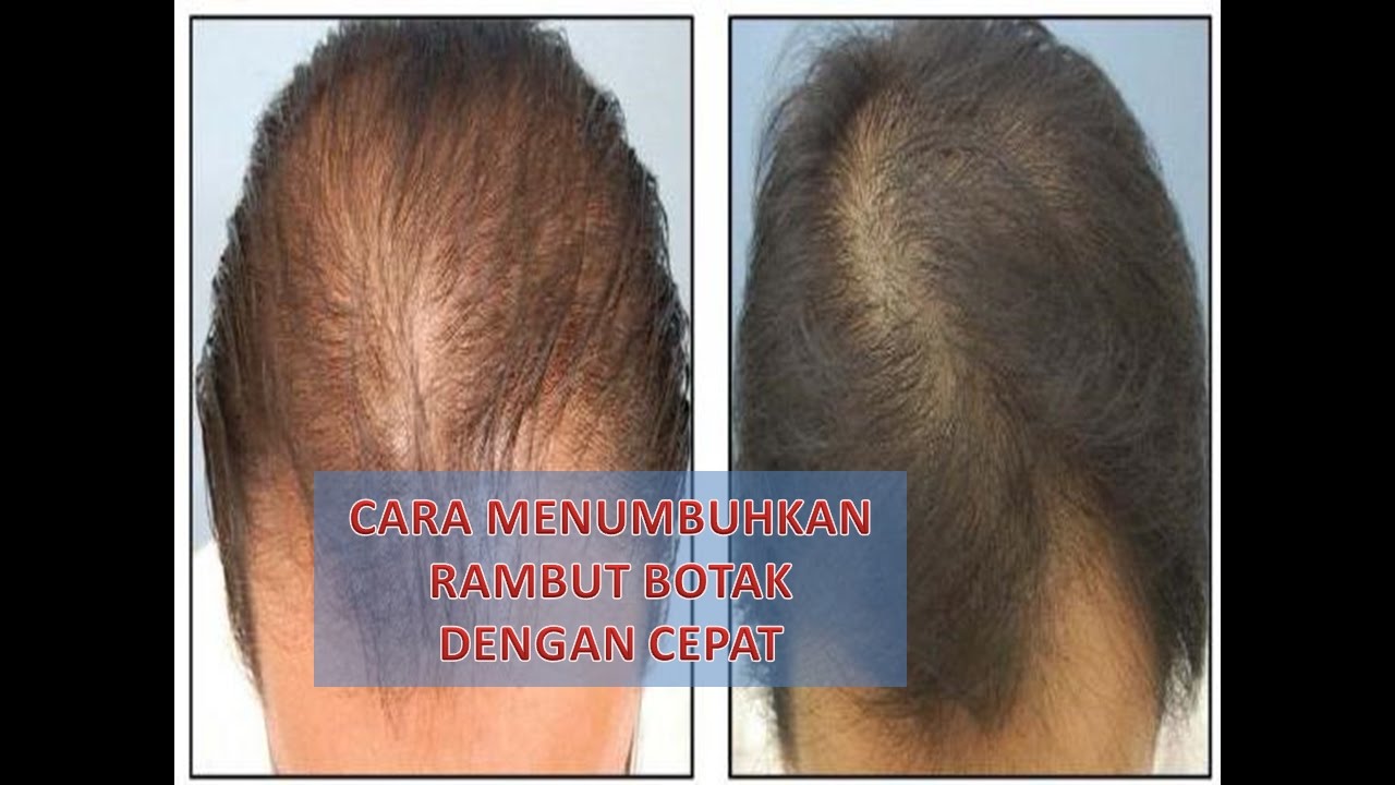 Ucapkan Selamat Tinggal pada Kebotakan: Panduan Lengkap Menumbuhkan Rambut Kembali