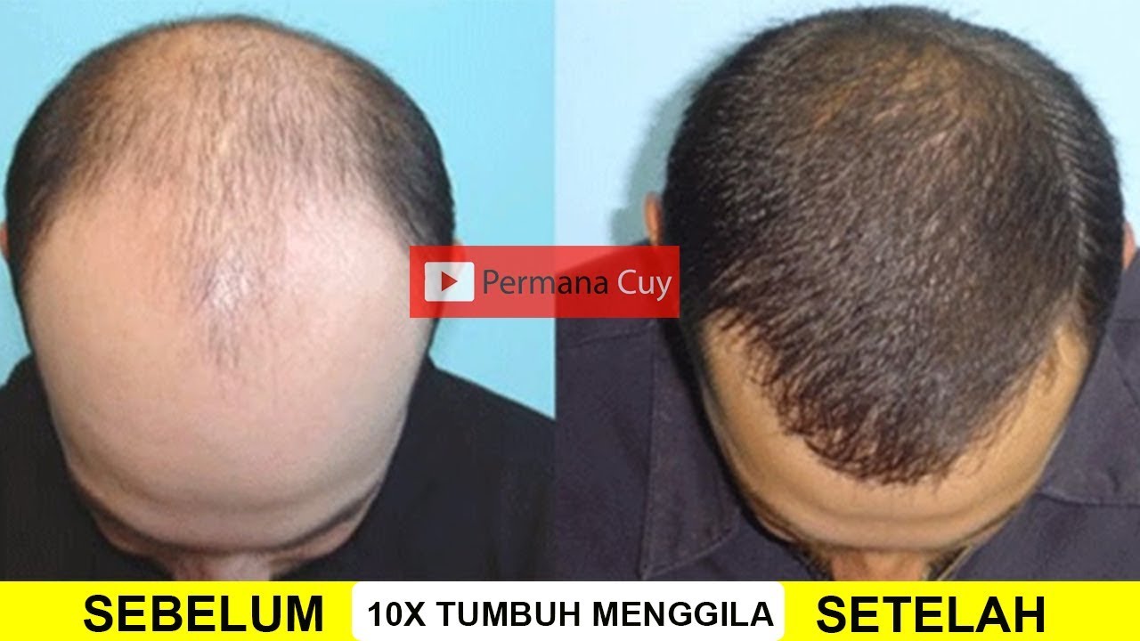 Rahasia Rambut Cepat Tumbuh: Taklukkan Mimpi Rambut Panjangmu!