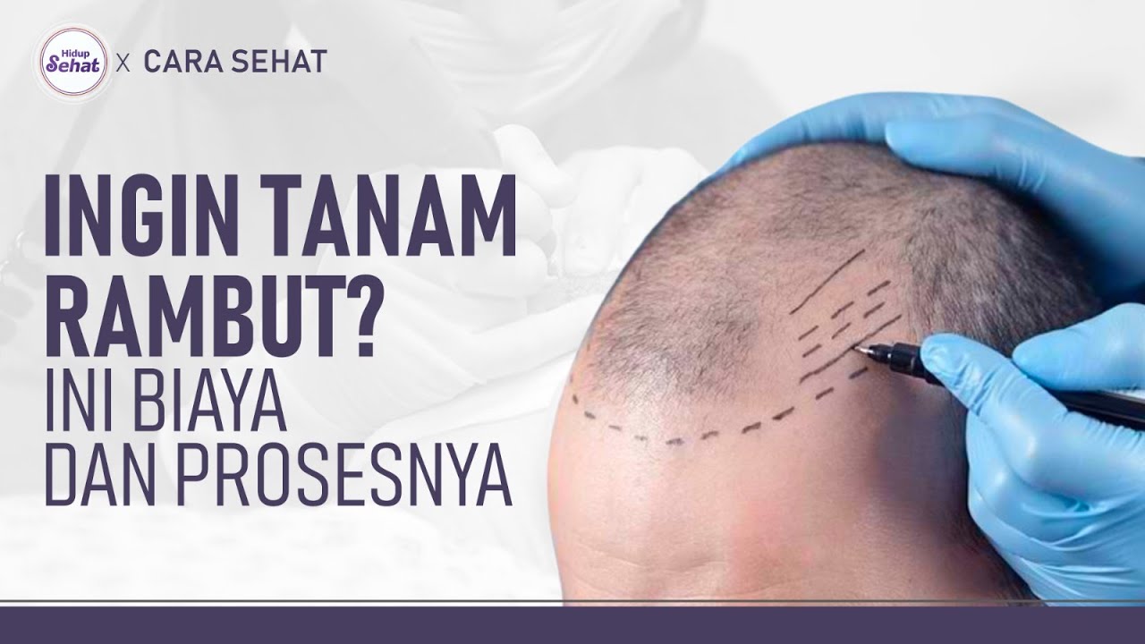 Mencari Solusi Rambut Rontok? Tanam Rambut Bisa Jadi Jawabannya!