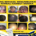 Rambut Botak Tengah: Mengungkap Rahasia Kehilangan Rambut di Area Tengah Kepala