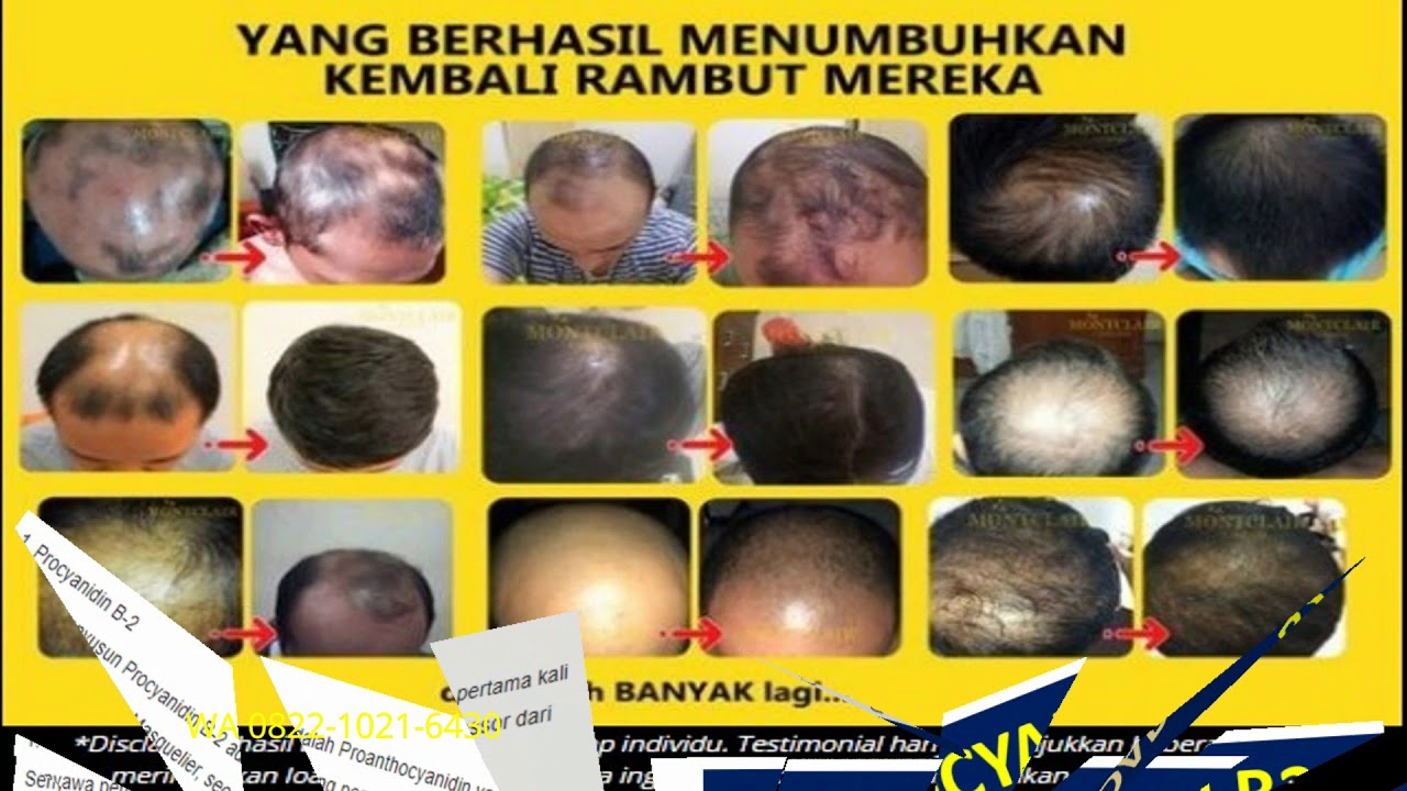 Rambut Botak Tengah: Mengungkap Rahasia Kehilangan Rambut di Area Tengah Kepala