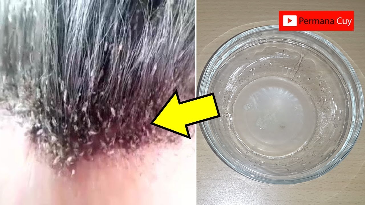 Perangi Kutu Rambut dengan Cara Efektif!