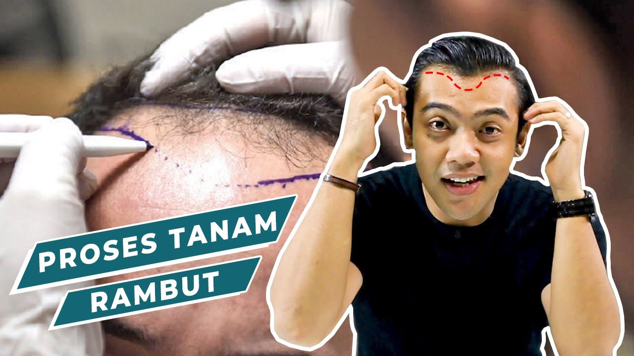 Mencari Solusi Rambut Rontok? Tanam Rambut Bisa Jadi Jawabannya!