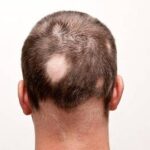 Hilangkan Pitak Akibat Alopecia Areata: Panduan Lengkap Menuju Rambut Sehat Kembali