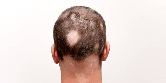 Hilangkan Pitak Akibat Alopecia Areata: Panduan Lengkap Menuju Rambut Sehat Kembali