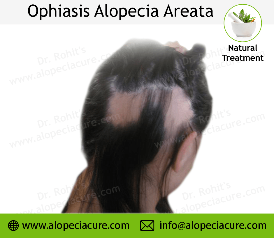 Hilangkan Pitak Akibat Alopecia Areata: Panduan Lengkap Menuju Rambut Sehat Kembali