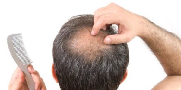 Rambut Rontok Bikin Stres? Tenang, Atasi dengan Cara Ini!