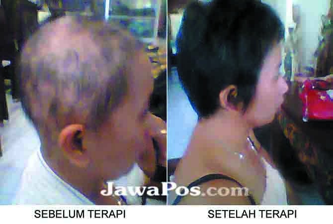 Rambut Rontok, Takdir atau Solusi?