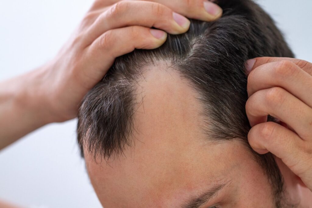 Apakah Rambut Rontok Bisa Dikendalikan dengan Vitamin Rambut?