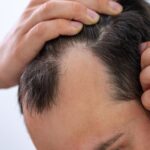 Apakah Rambut Rontok Bisa Dikendalikan dengan Vitamin Rambut?