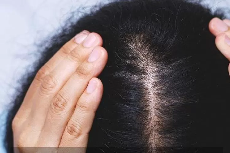 Cara Efektif Mengatasi Rambut Rontok Di Rumah: Selamat Tinggal Rambut Rontok, Halo Rambut Sehat!