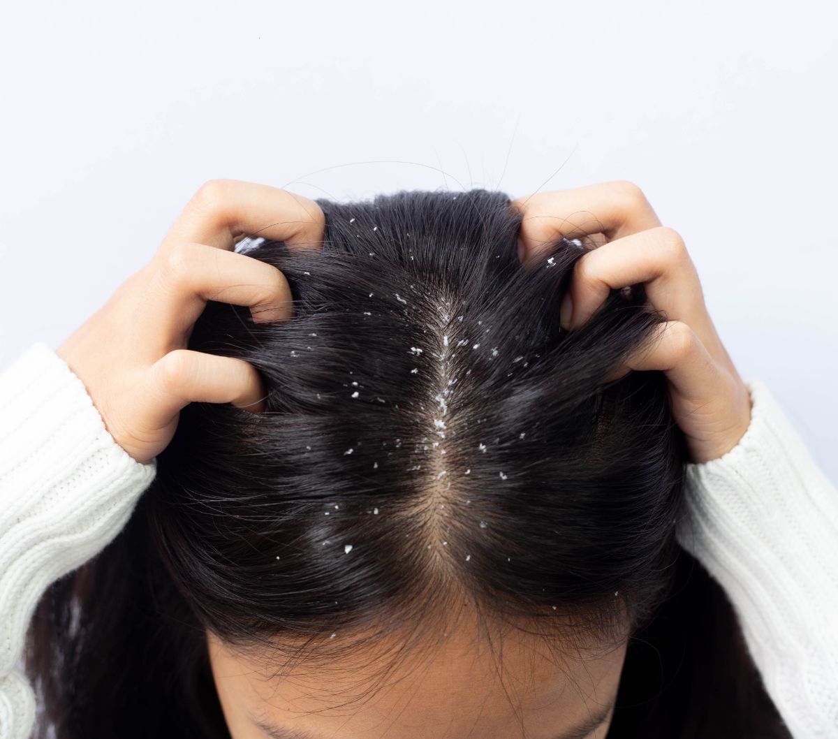 Rambut Berketombe Kronis? Jangan Panik, Coba Solusi Alami Ini!