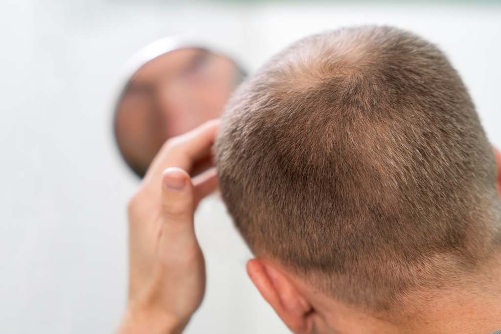 Rambut Pitak: Mengungkap Penyebab dan Solusi Terbaik untuk Tampilan Lebih Penuh