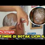 Rambut Berketombe Hilang Total dengan Bahan Dapur Ini!