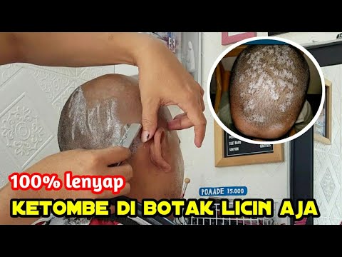 Rambut Berketombe Hilang Total dengan Bahan Dapur Ini!