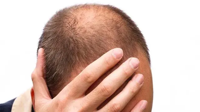 Tips Menumbuhkan Rambut di Area Botak Secara Efektif