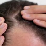 Cara Mengatasi Rambut Botak Secara Efektif: Kembalikan Kepercayaan Diri Anda!