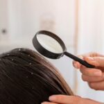 Cara Menghilangkan Ketombe Basah dengan Bahan Alami: Rambut Sehat, Bebas Gatal!