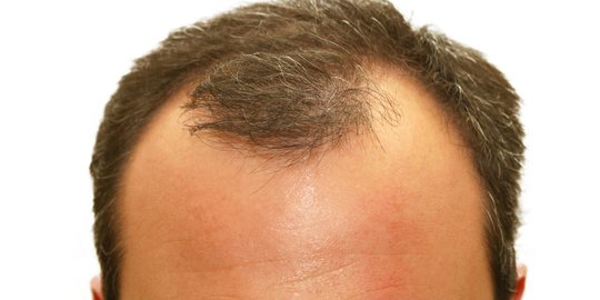 Tips Menumbuhkan Rambut di Area Botak Secara Efektif