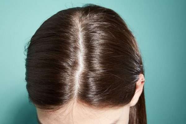 Cara Mengatasi Rambut Tipis di Depan: Rahasia Rambut Tebal dan Sehat