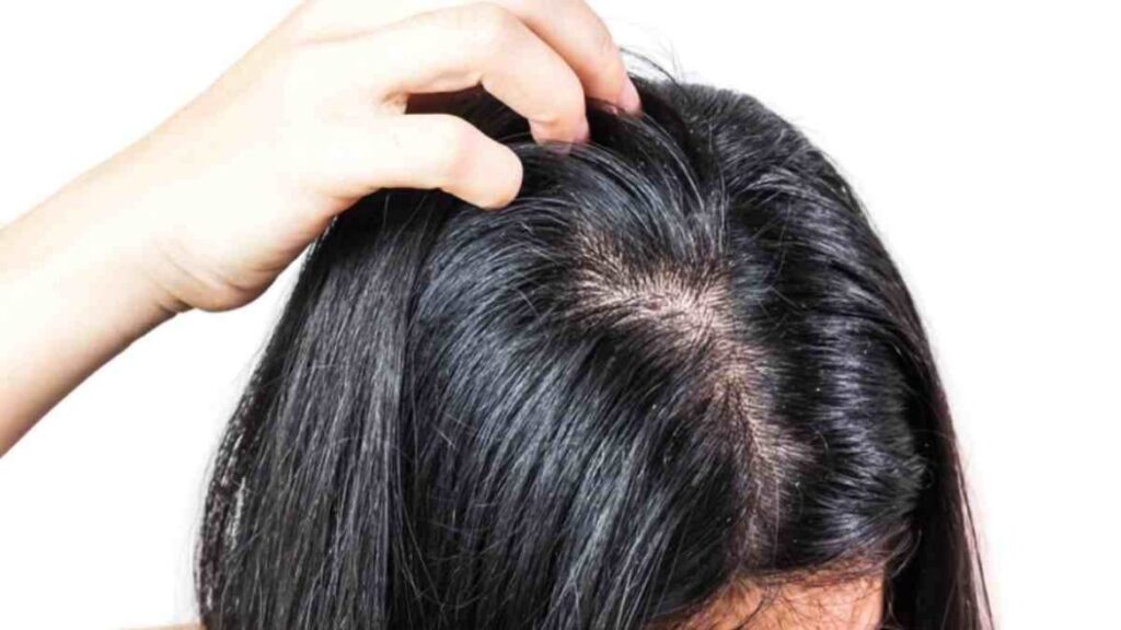 Solusi Rambut Lepek dan Berminyak dengan Cara Alami: Ucapkan Selamat Tinggal pada Rambut Kusam!