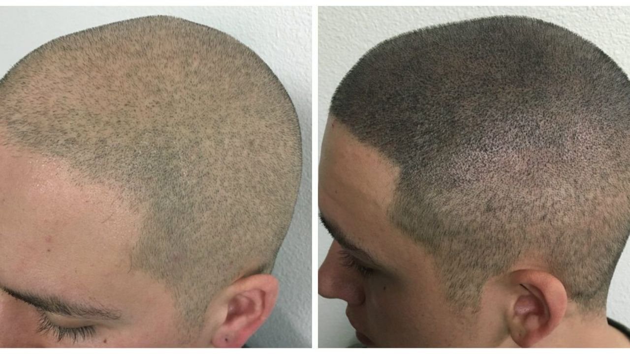 Scalp Micropigmentation (SMP): Solusi Instan untuk Kebotakan?