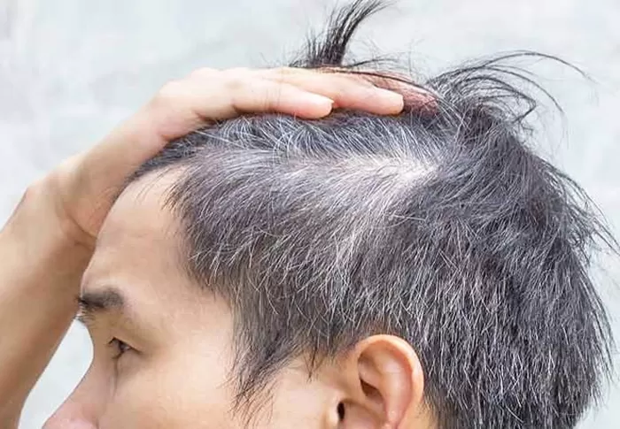 Bagaimana Cara Mengatasi Rambut Beruban di Usia Muda?