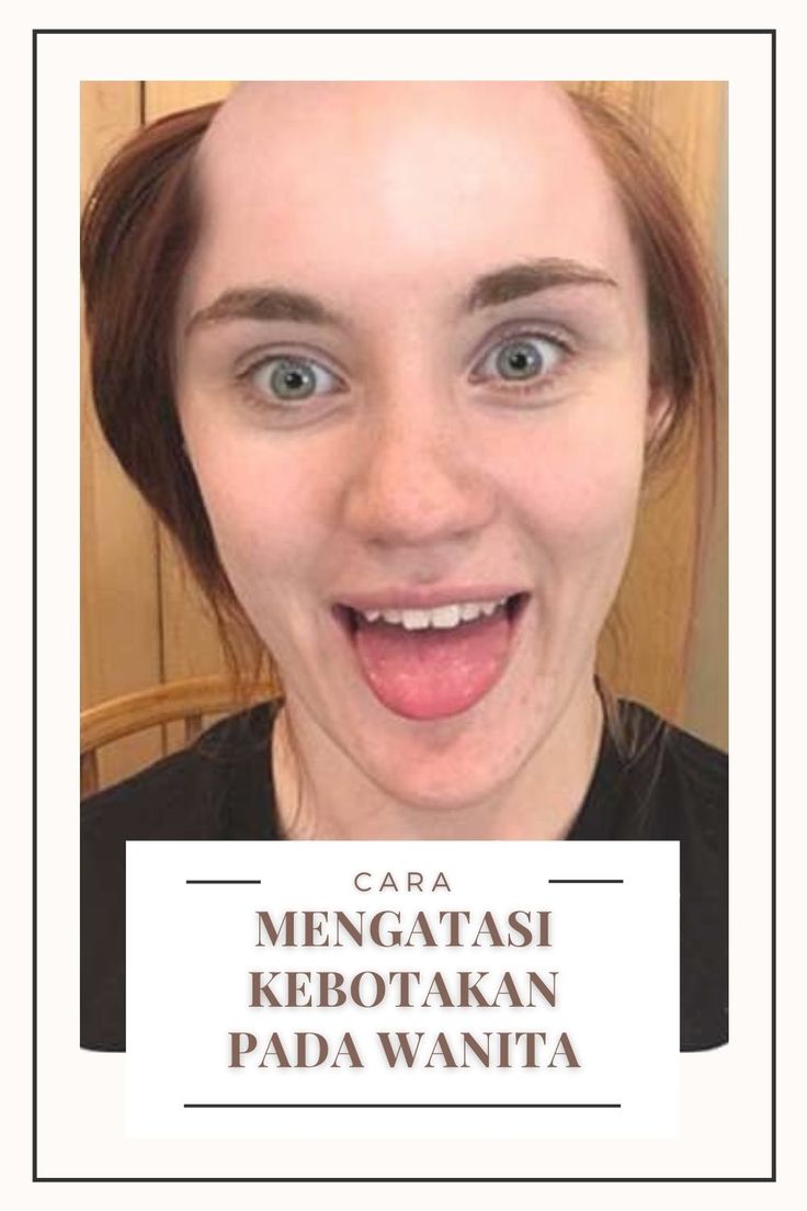 Cara Mengatasi Rambut Botak Secara Efektif: Kembalikan Kepercayaan Diri Anda!