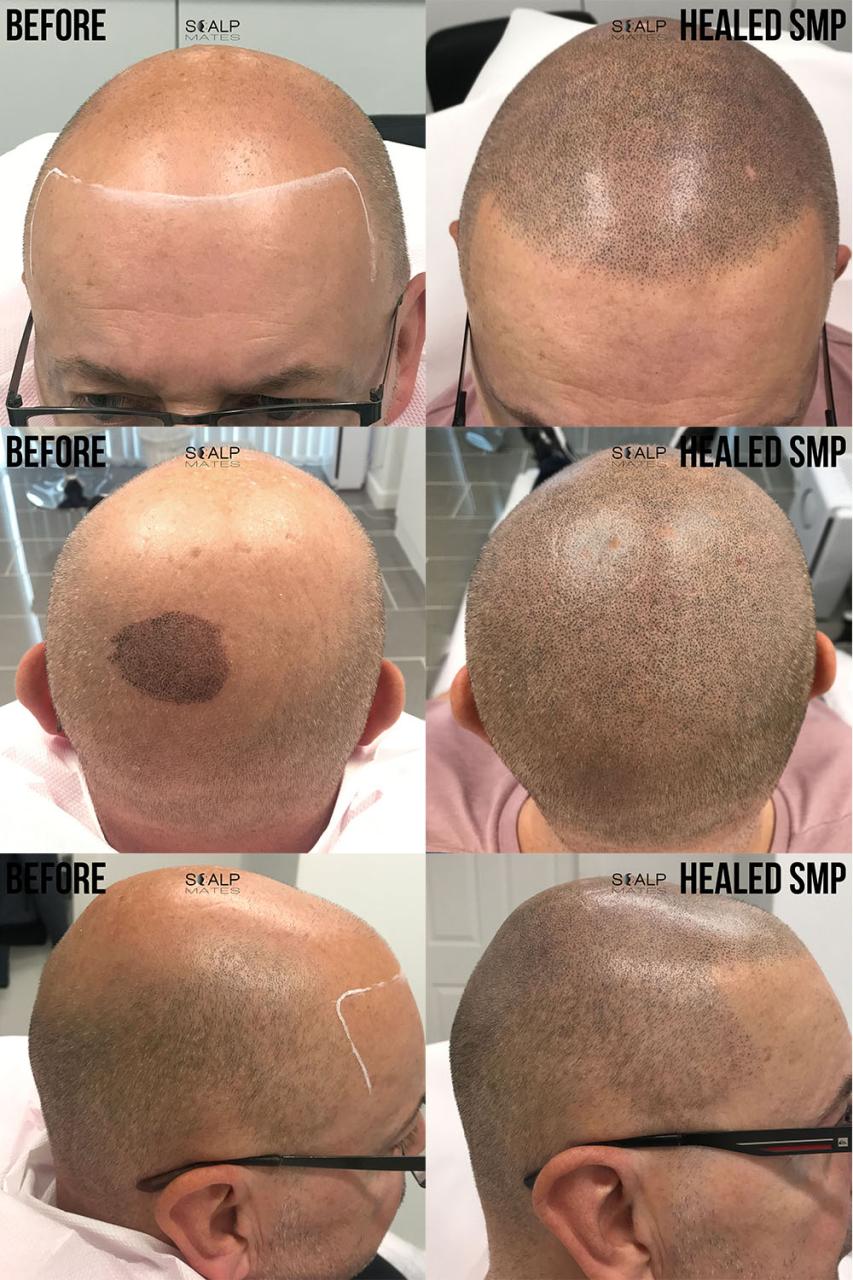 Scalp Micropigmentation (SMP): Solusi Instan untuk Kebotakan?