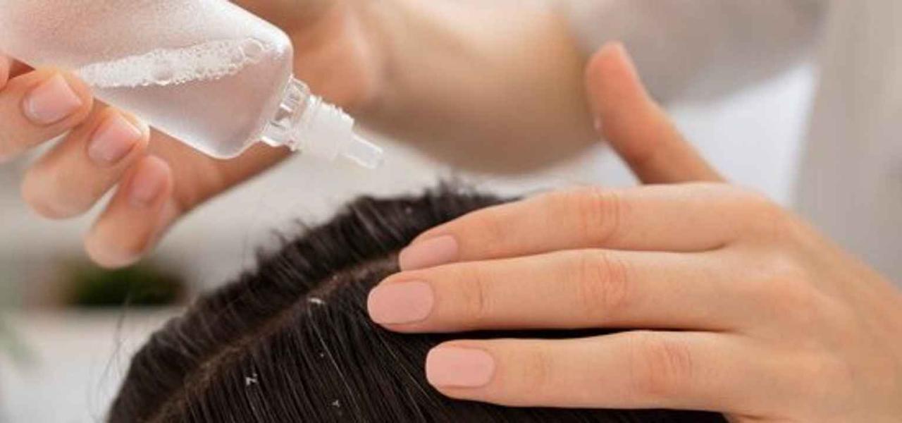 Rambut Rontok dan Gatal Karena Ketombe? Atasi Secara Alami dengan Tips Ini!