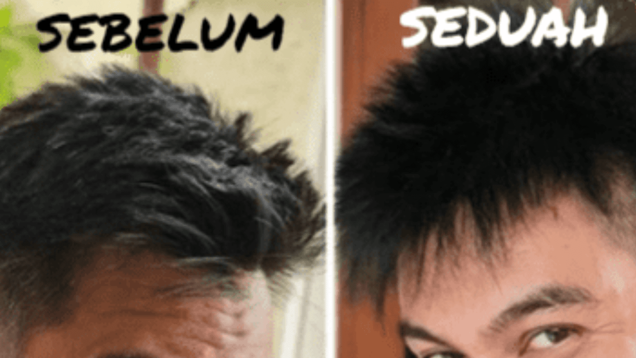 Mengatasi Rambut Beruban karena Stres: Tips dan Trik