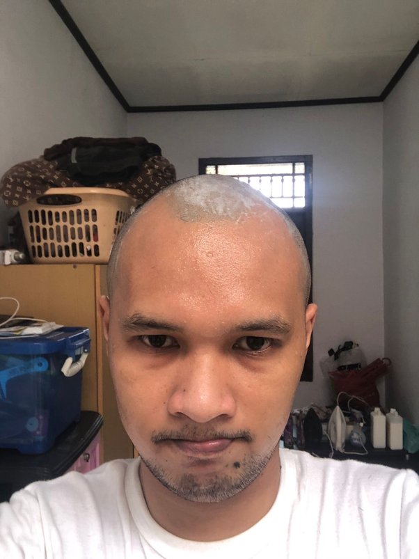 Pengaruh Hormon Terhadap Kerontokan Rambut: Apa yang Perlu Kamu Ketahui