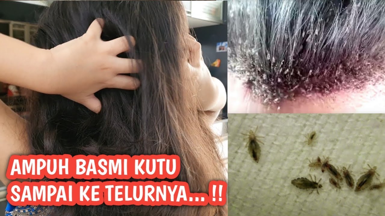 Cara Menghilangkan Kutu Rambut Secara Alami dan Efektif