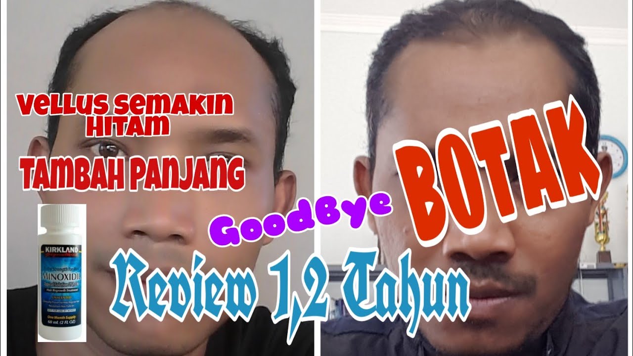 Minoxidil untuk Rambut Rontok: Cara Kerja, Efek Samping, dan Penggunaan yang Tepat