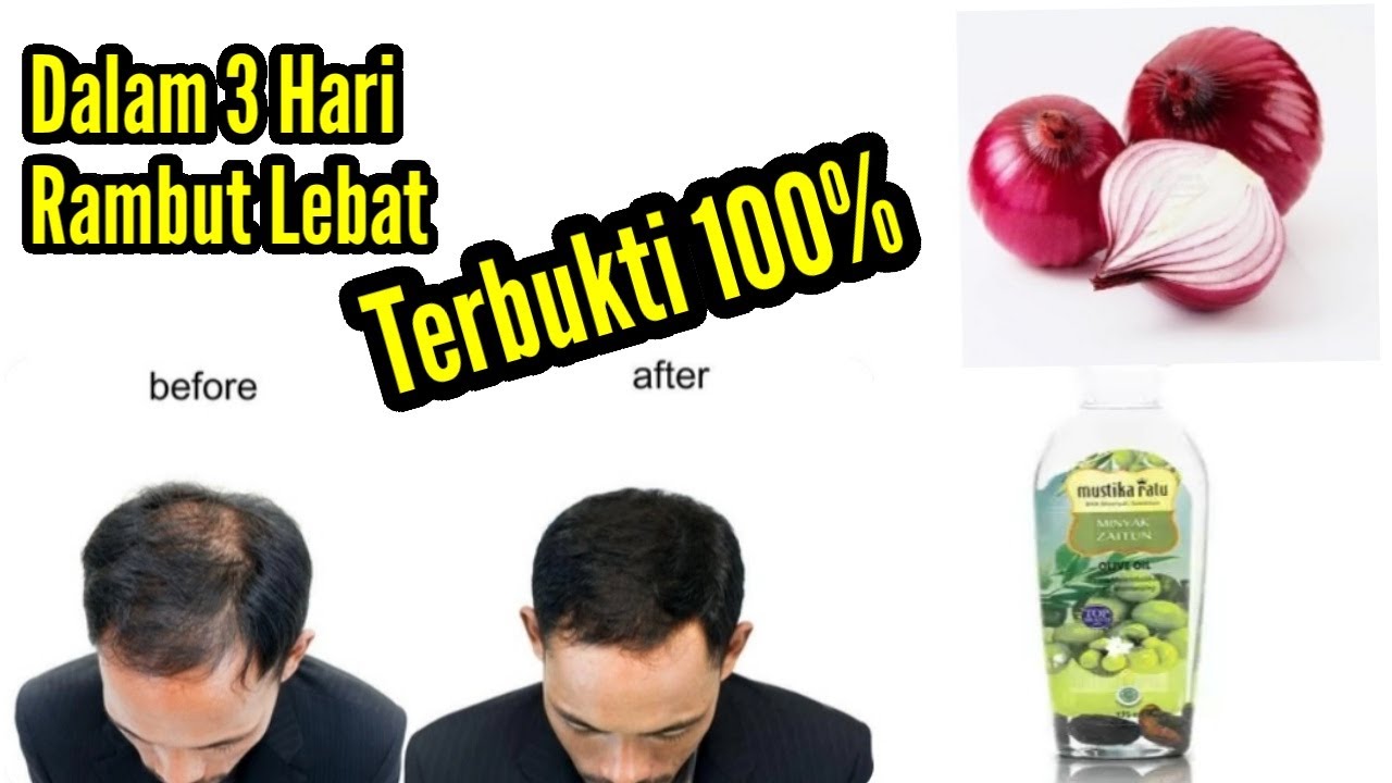 Bagaimana Cara Mengatasi Rambut Botak di Bagian Depan?