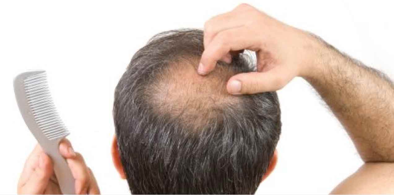 Rambut Anda Rontok Parah? Simak Tips Ampuh Mengatasinya!