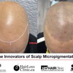 Scalp Micropigmentation (SMP): Solusi Instan untuk Kebotakan?