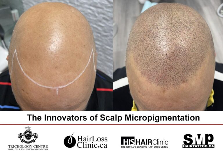 Scalp Micropigmentation (SMP): Solusi Instan untuk Kebotakan?